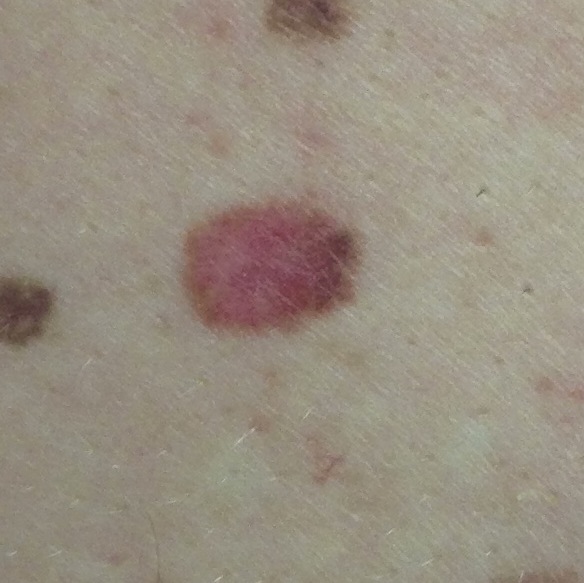 Skin cancer picture 1