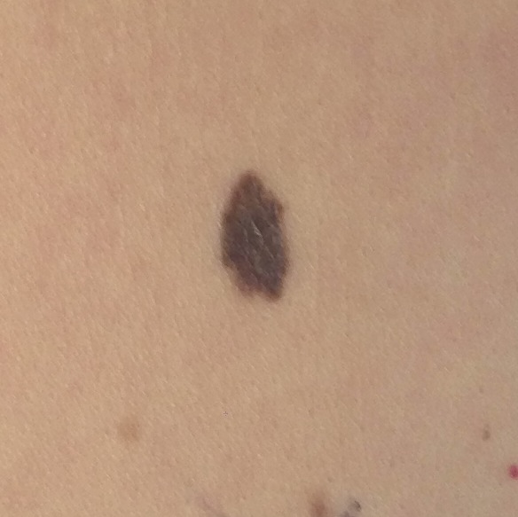 Skin cancer picture 2