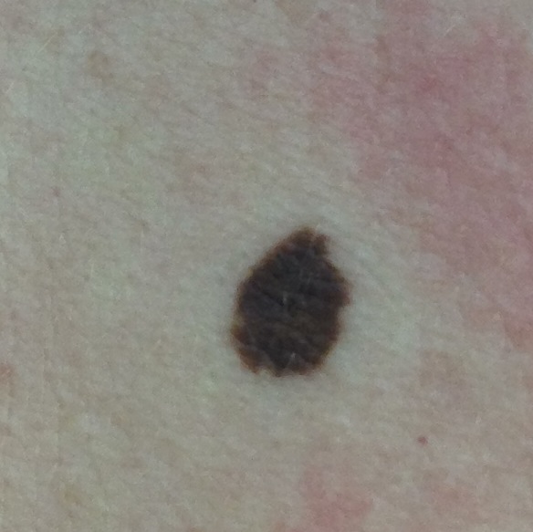 Skin cancer picture 3