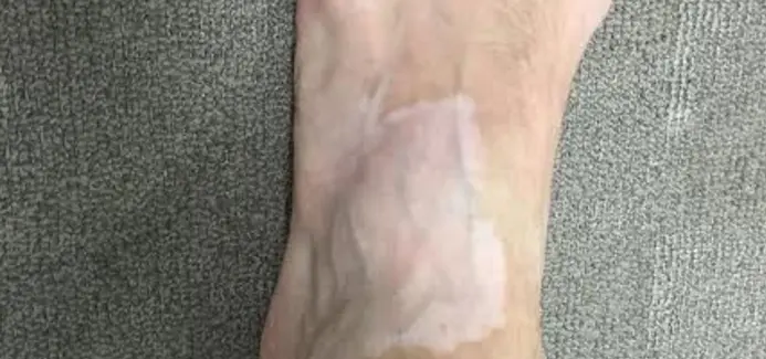 Developed vitiligo spot on the feet