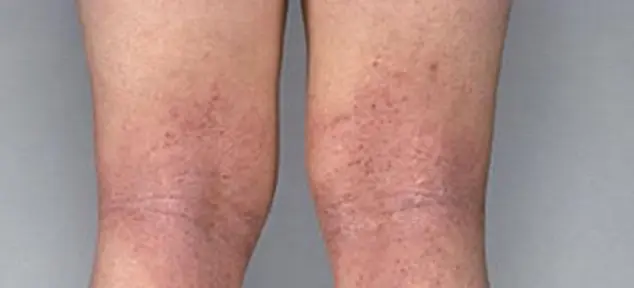 Eczema on the legs