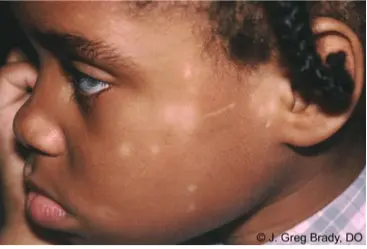 Example picture of pityriasis alba