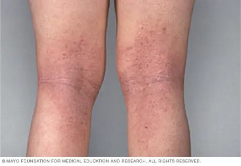 Example picture of Eczema