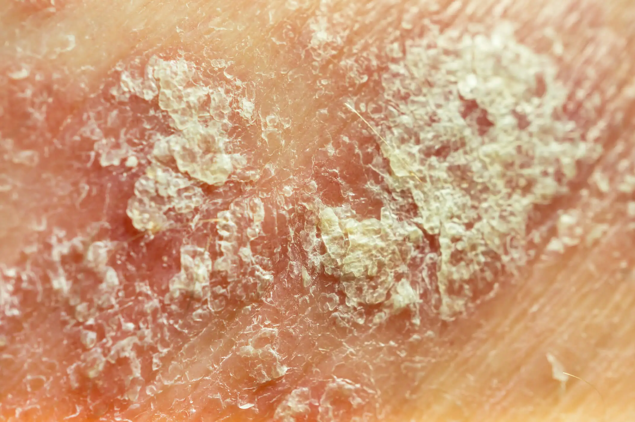 Eczema on the skin causing itchy patches with visible scaling and dryness.		