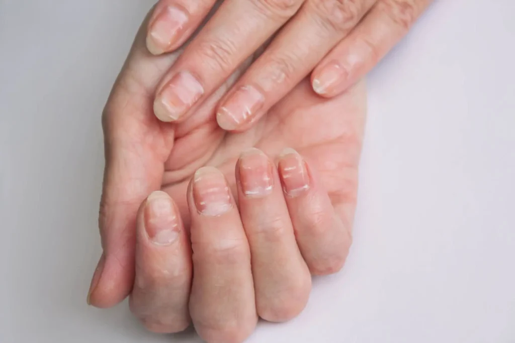 Leukonychia showing white spots on the nails caused by trauma or underlying systemic issues		