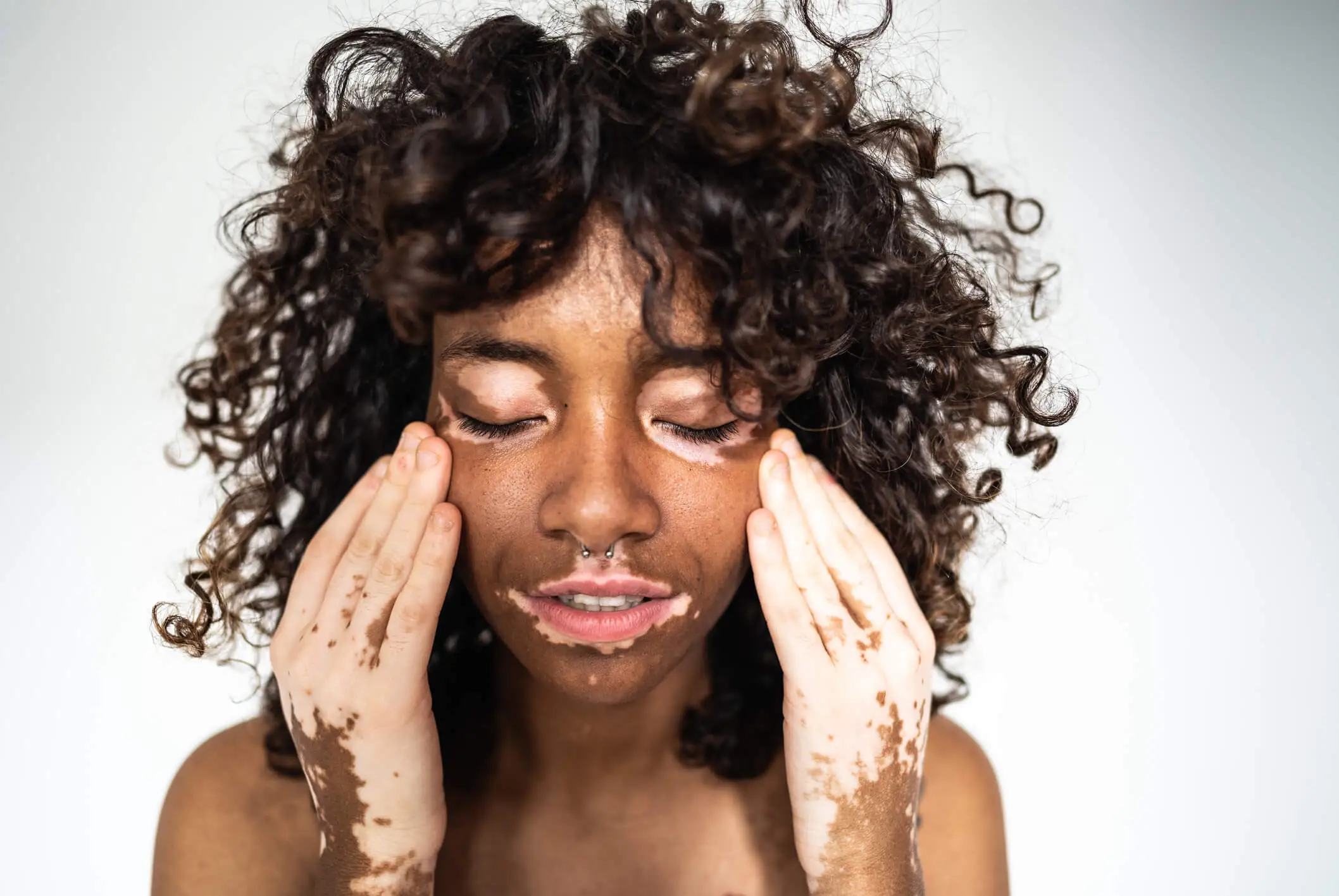 face with vitiligo, showing depigmented patches. White spots in the skin